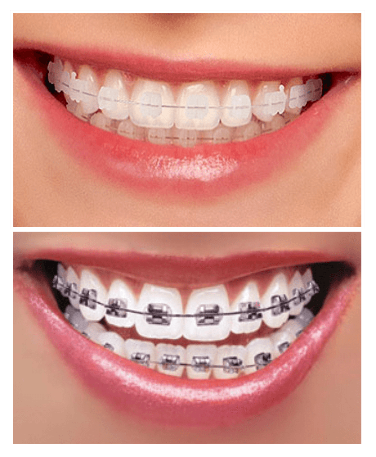 Clear Braces Irwin Greensburg PA Invisalign Matthews Orthodontics